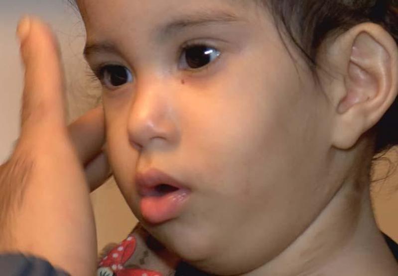 Siyam ikizleri iyileşti taburcu oluyor