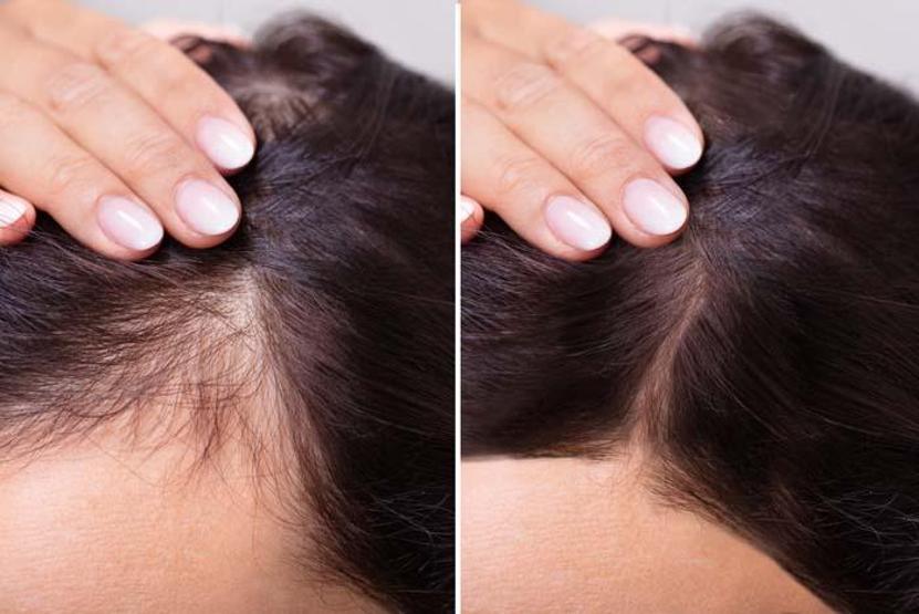 Saçları tel tel döküyor Kansızlıktan vitamin eksikliğine uzman isim saç dökülmesine neden olan etkenleri tek tek sıraladı Saç dökülmesi nasıl önlenir