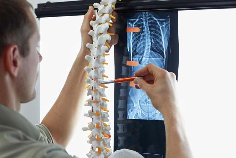 Uzmanından skolyoz uyarısı: Ciddi ve çok ileri eğriliklerde ani ölüm riski yüksektir