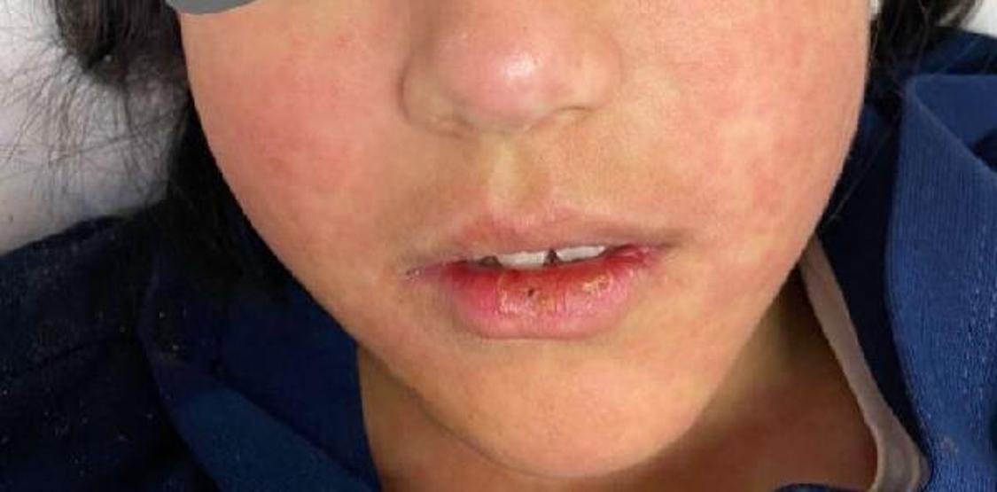 Uzman isimden kızamık uyarısı: Yıllar sonra ilk kez bir kızamık vakasını hastaneye yatırdık