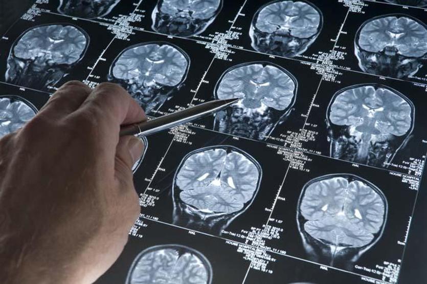 Alzheimerın ana sebebi Bu alışkanlıklar hastalığı tetikliyor