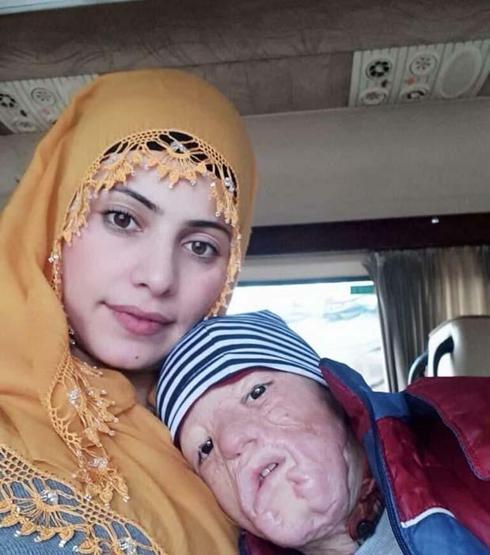 Yangında yaralanan 9 yaşındaki Halil, 3üncü kez doku nakli için bekliyor