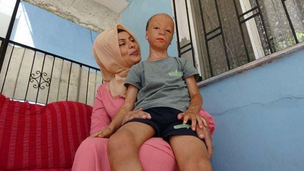 Yangında yaralanan 9 yaşındaki Halil, 3üncü kez doku nakli için bekliyor