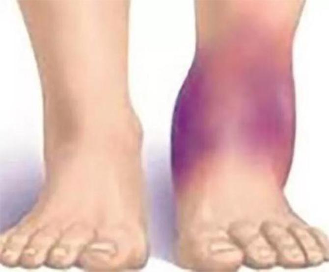 Depremzedelerde sık görülen hastalık: Kompartman sendromu Belirtileri neler