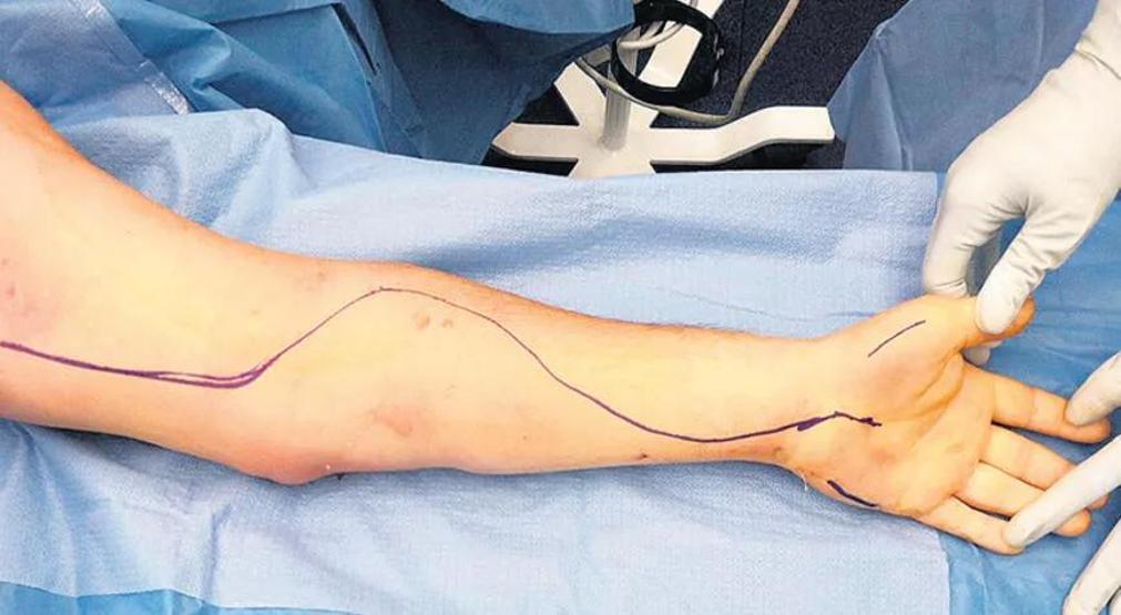 Depremzedelerde sık görülen hastalık: Kompartman sendromu Belirtileri neler