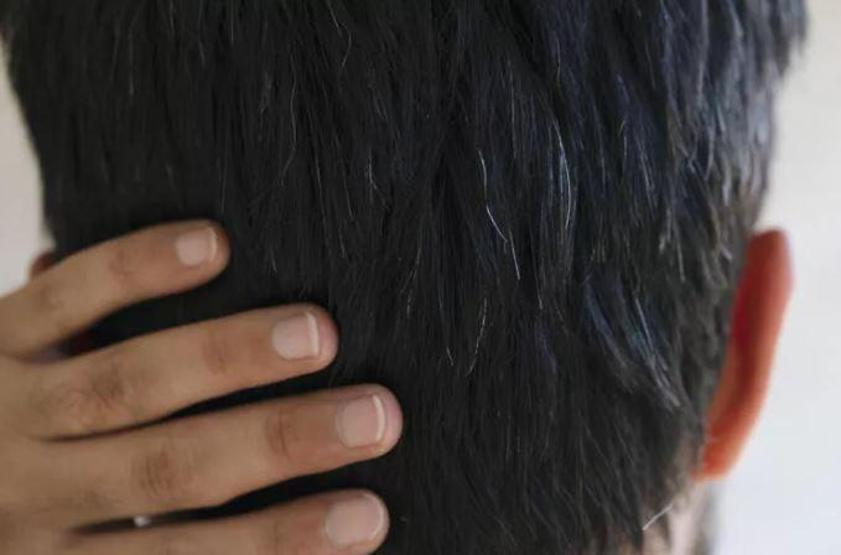 Bu vitamini vücudunuzdan eksik etmeyin Eksikliği saçları erkenden beyazlatıyor