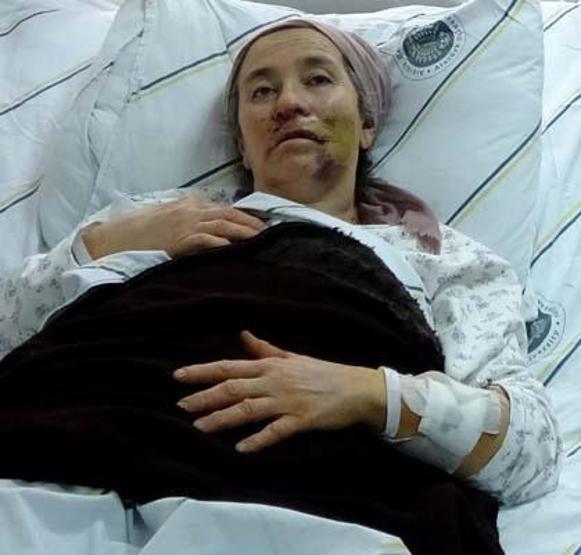 Kurdun saldırısına uğrayan 4 kişi yaralanmış, kurt kuduz çıkmıştı: Önce yüzünü ısırmış