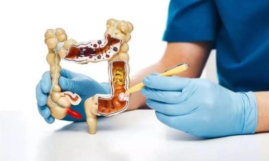 Bu kanseri engellemek mümkün Kolon kanserine karşı 5 etkili yöntem