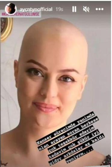 Kanserle mücadele eden oyuncu Ayçin Tuyun peruksuz fotoğrafını paylaştı