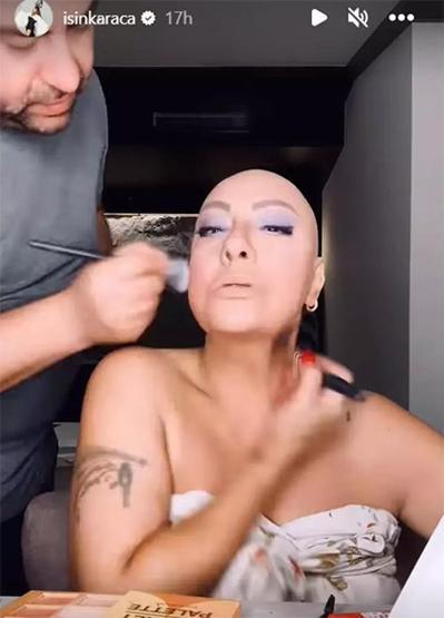 Saç kıran hastalığına yakalanmıştı Işın Karaca peruksuz halini paylaştı