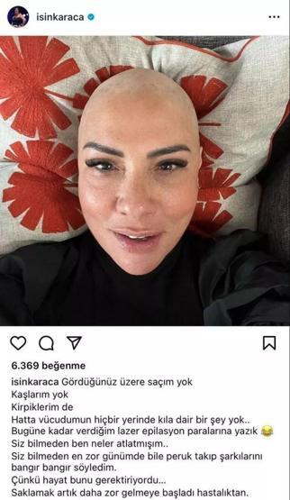 Saç kıran hastalığına yakalanmıştı Işın Karaca peruksuz halini paylaştı