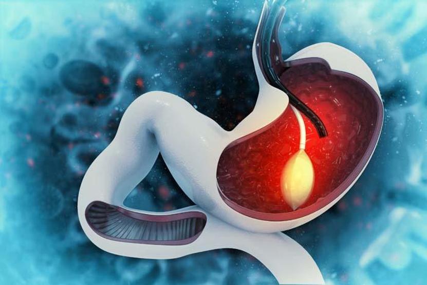Obezite ameliyatları için dört hayati uyarı