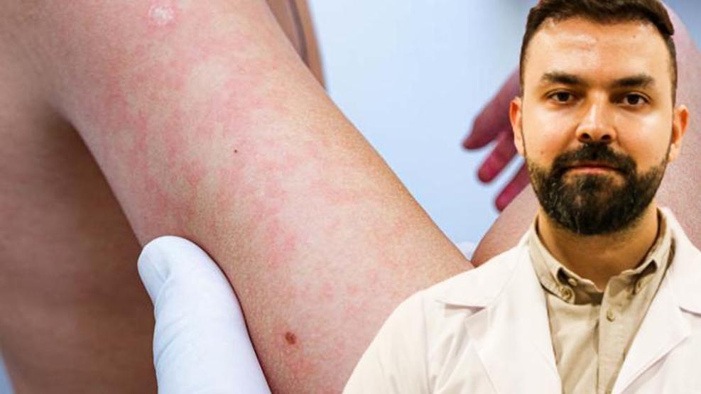 Uyuz vakaları yüzde 30 arttı, bazı kremlere direnç göstermeye başladı Uyuz nasıl geçer Sirke veya sirkeli su işe yarıyor mu Dermatoloji Uzmanı açıkladı