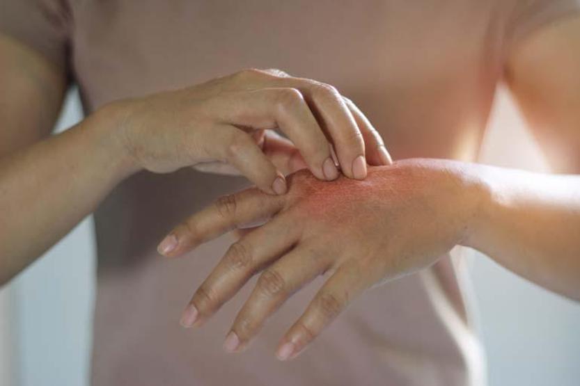 Uyuz vakaları yüzde 30 arttı, bazı kremlere direnç göstermeye başladı Uyuz nasıl geçer Sirke veya sirkeli su işe yarıyor mu Dermatoloji Uzmanı açıkladı