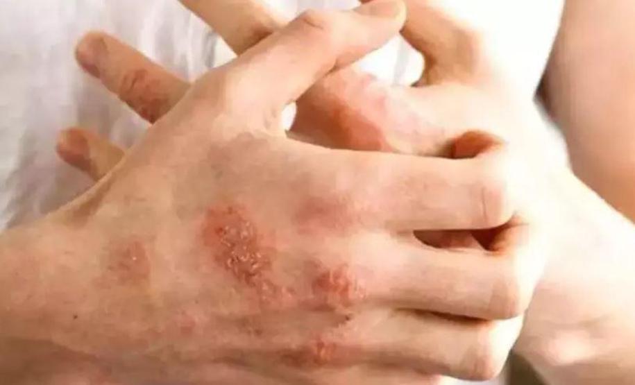 Bu alışkanlıklar egzamaya davetiye çıkarıyor