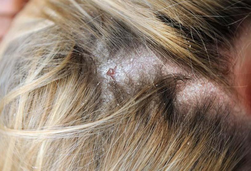 Bugünlerde en sık görülen 5 cilt sorunu Soğuk havada cilt sağlığını korumanın püf noktaları