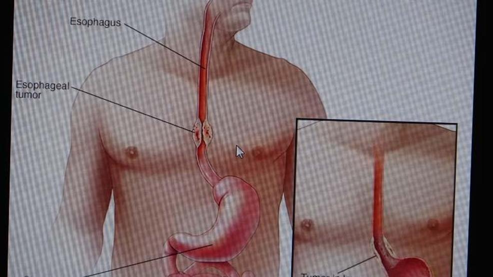 5 BELiRTiYE DİKKAT Dünyada en sık görülen 9. kanser türü Risk faktörleri tek tek sıralandı: Çok sıcak içecekler tüketmeyin, çünkü...