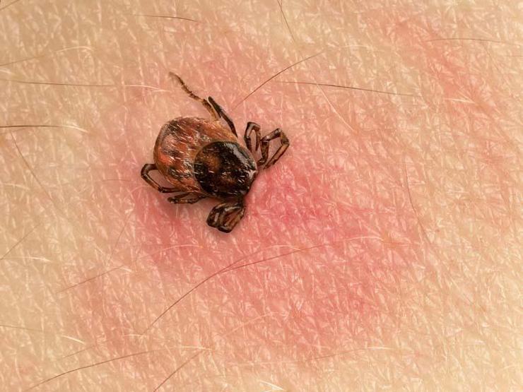 Hayalet hastalık ‘lyme’a dikkat: 300 hastalığı taklit ediyor