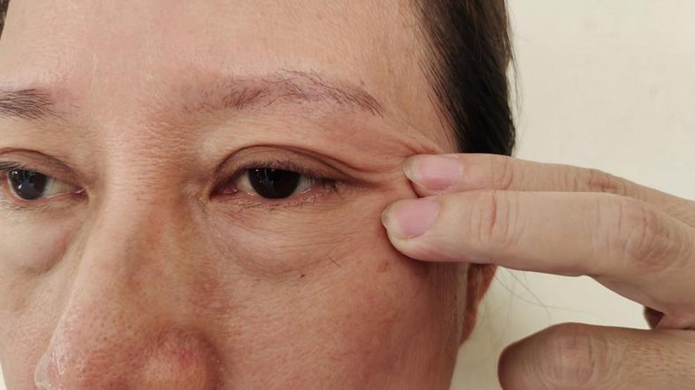 Göz altı morlukları kaderiniz olmasın Düzenli şekilde kullanın, morluklar nasıl gidiyor görün: Mucize yöntem