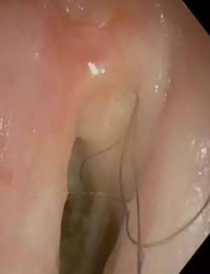 Doktorlar bile şoke oldu Ses kısıklığı, öksürük, nefes almada zorluk Sigara bu kez öyle bir şeye sebep oldu ki...