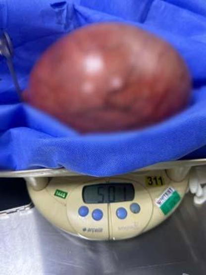 KARIN AĞRISI DEYİP GEÇME 5,5 kilo kitle çıktı