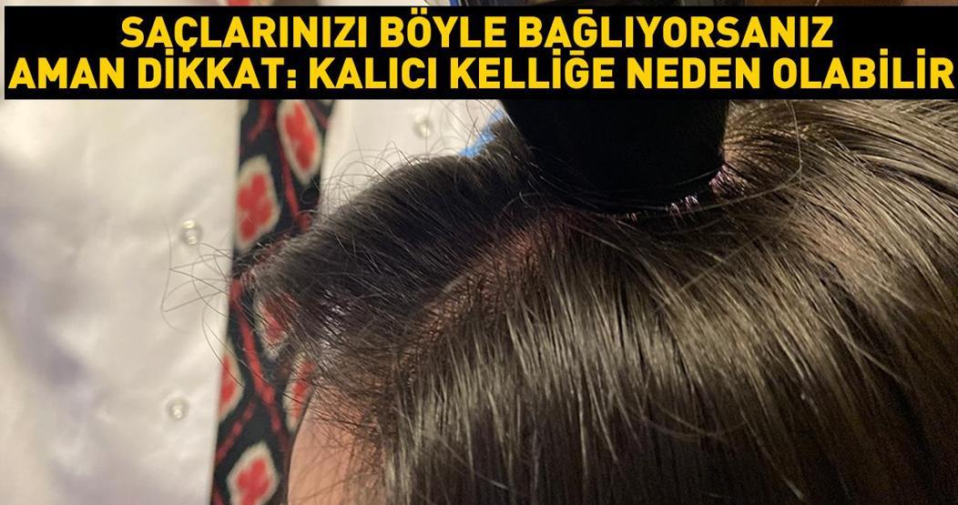 Saçlarınızı böyle bağlıyorsanız aman dikkat: Kalıcı kelliğe yol açabilir