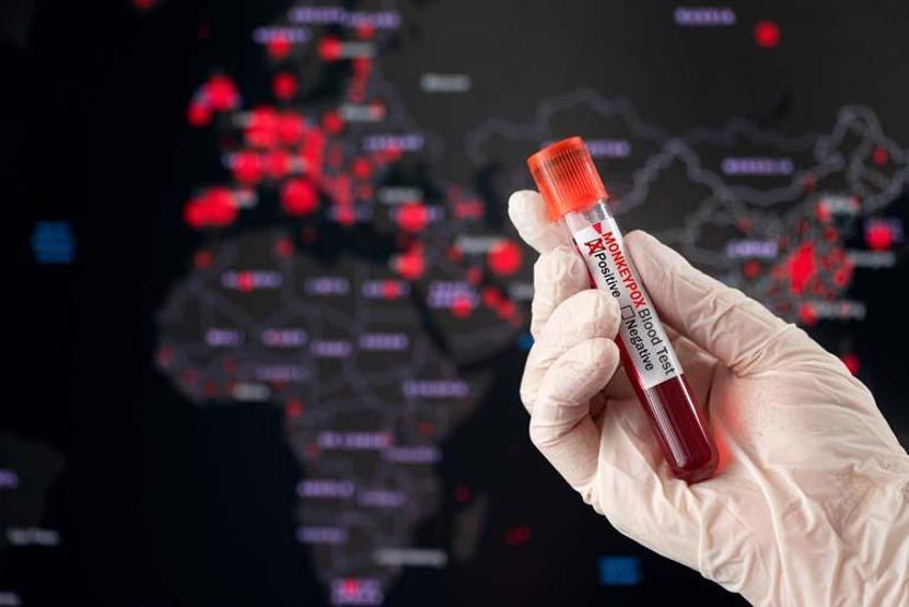 Maymun Çiçeği Virüsü kapıda mı 5 kritik belirti Maymun Çiçeği virüsü bir Covid-19 vakası mı Nasıl bulaşıyor Tüm merak edilenler