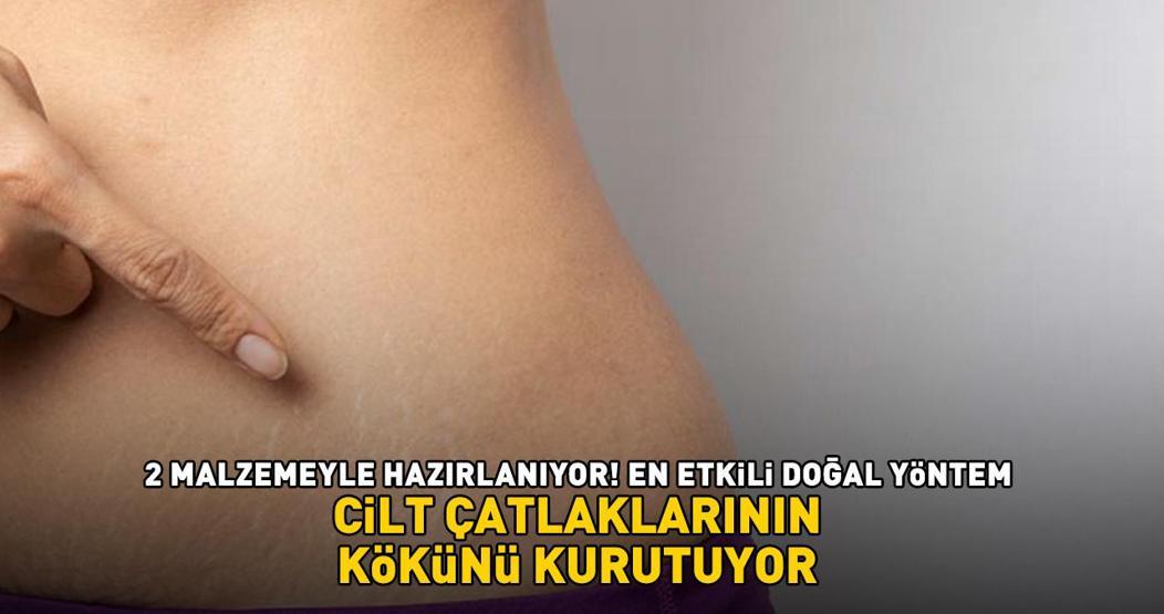 CİLT ÇATLAKLARININ KÖKÜNÜ KURUTUYOR En etkili doğal yöntem 2 malzemeyle hazırlanıyor
