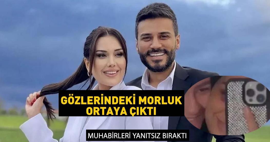 DİLAN POLATın gözlerinin altındaki morluklar dikkat çekti Sır gibi saklıyordu, ortaya çıktı