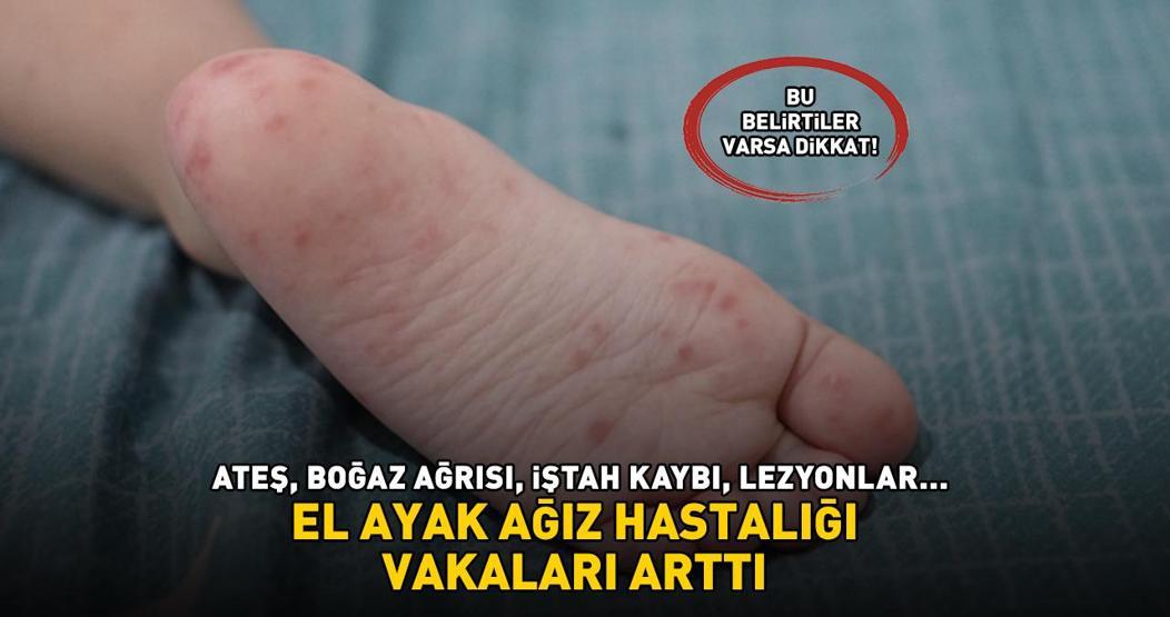 EL AYAK AĞIZ HASTALIĞI VAKALARI ARTTI, HASTANELER DOLDU TAŞTI Ateş, boğaz ağrısı, iştah kaybı, lezyonlar... Bu belirtiler varsa dikkat