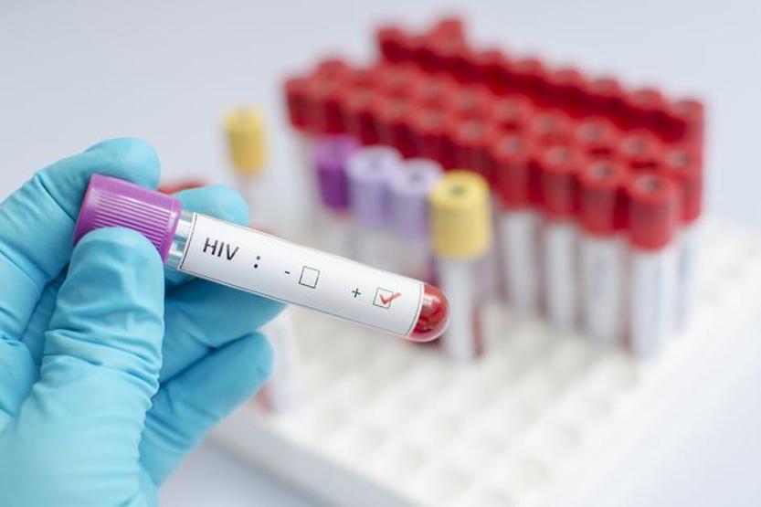 HIV POZİTİF NE DEMEK HIV nedir, nasıl bulaşır HIV ölümcül mü
