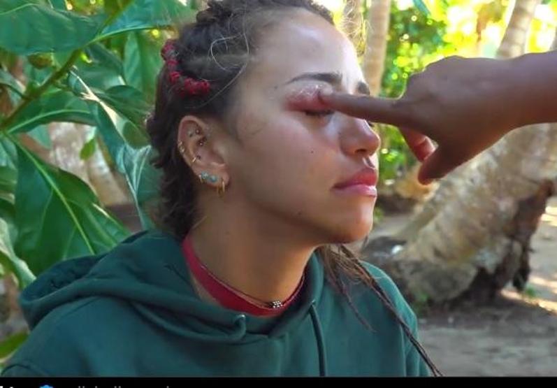 Survivorda acil durum Zeynepin gözünü Tarantula ısırdı Mosmor oldu