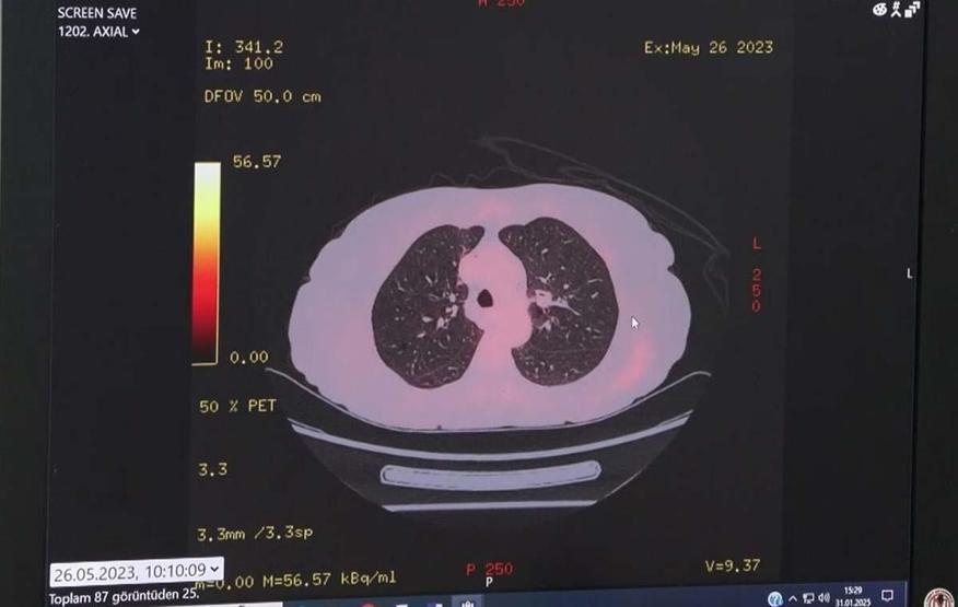Kanser Artışının En Önemli Nedenlerinden Biri; Yaşam Tarzı Değişiklikleri