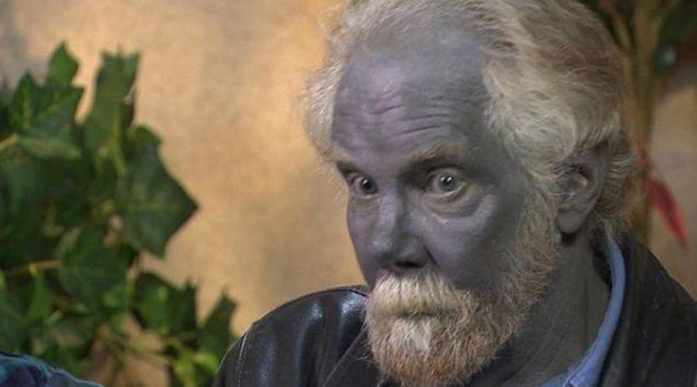 Bu hastalığa dikkat Kişilerin cildini maviye dönüştürüyor