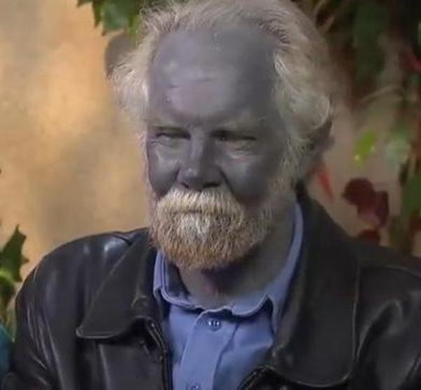 Bu hastalığa dikkat Kişilerin cildini maviye dönüştürüyor