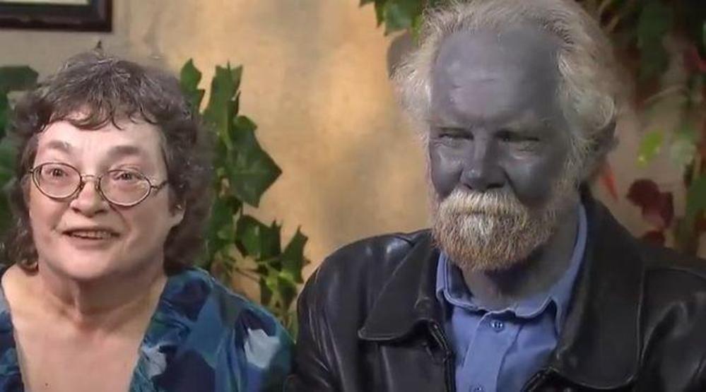 Bu hastalığa dikkat Kişilerin cildini maviye dönüştürüyor