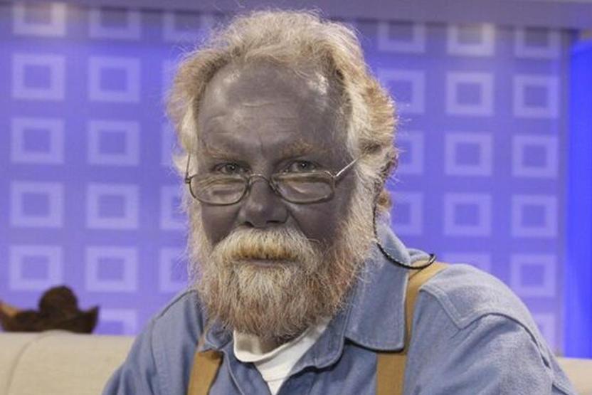 Bu hastalığa dikkat Kişilerin cildini maviye dönüştürüyor