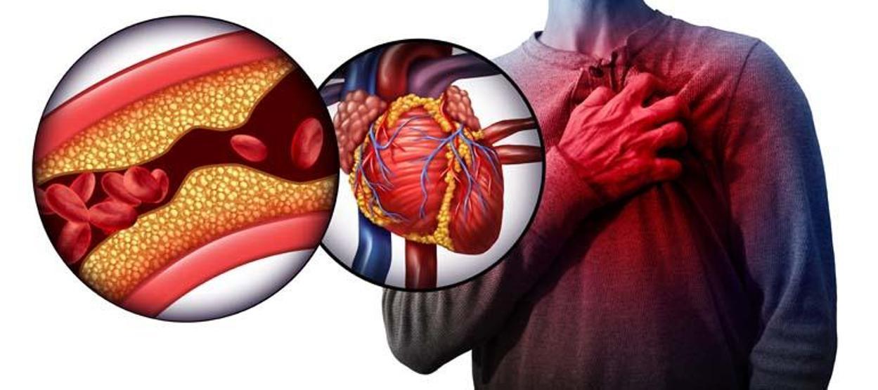 AORT Damarı Yırtılması Nedir, Nasıl Olur AORT Damarı Yırtılması Belirtileri Nelerdir