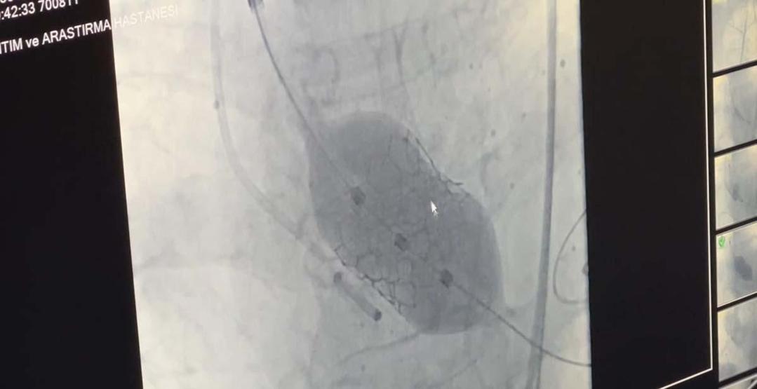 Dünyada 18’nci, Türkiye’de ilk: 4 yaprakçıklı aort kapağına TAVİ operasyonu