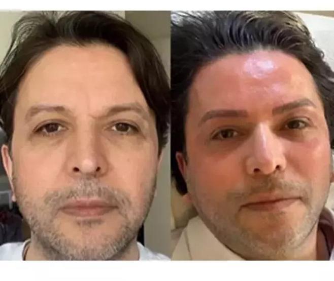 ESTETİK Mİ YAPTIRDI Nihat Doğanın son hali şoke etti