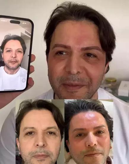 ESTETİK Mİ YAPTIRDI Nihat Doğanın son hali şoke etti