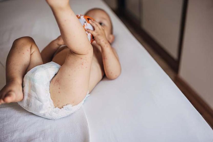 Çocuklarda el, ayak, ağız hastalığına dikkat Uzman isim belirtilerini anlattı
