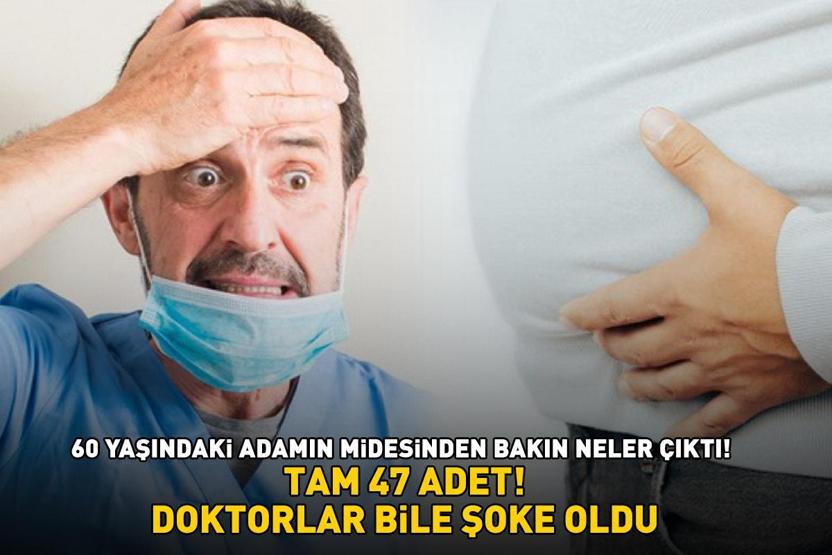 TAM 47 ADET 60 yaşındaki adamın midesinden bakın neler çıktı Doktorlar bile şaştı kaldı