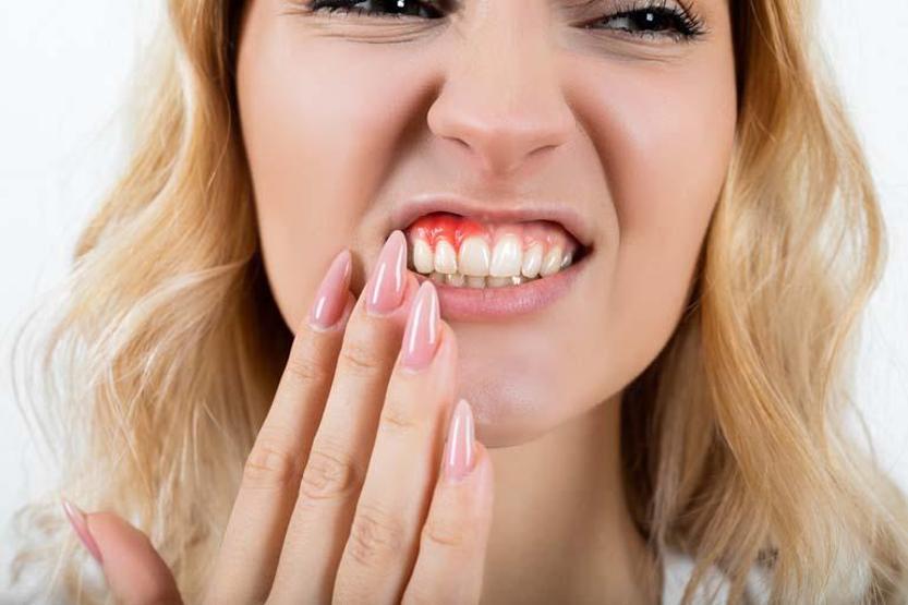 C Vitamini Eksikliği Dişleri Vuruyor Diş Eti Kanamasının Başlıca Sebepleri... Diş Eti Kanamasından Korunmak İçin Öneriler