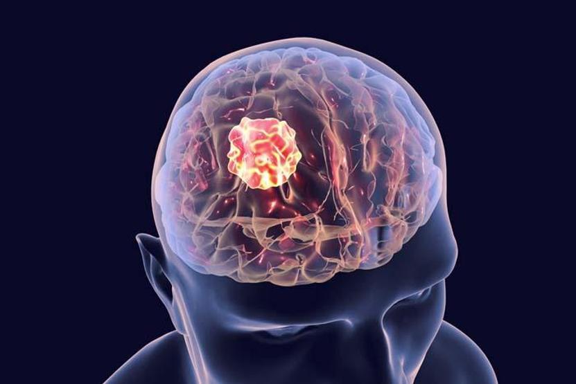 Çağın Kabusu: Beyin Damarlarında Birikerek Kan Akışını Engelliyor Alzheimer, Demans, İnme... Zihinsel Hastalıklarda Vakalar Patladı Mikroplastikler Beyinde Nasıl Birikiyor