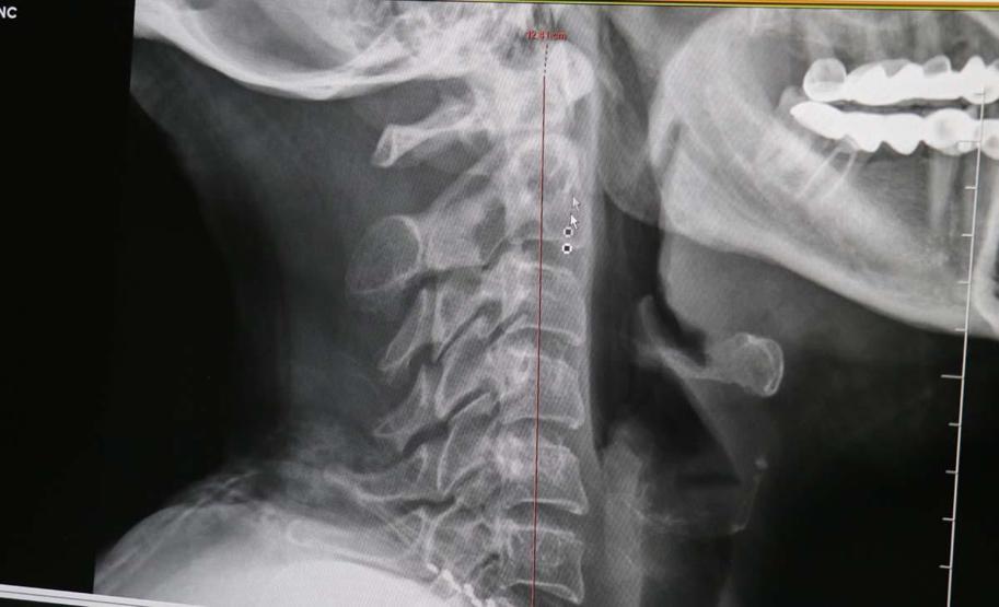 Bu Hastalık 10 Yaş Altına Düştü Sebebi Aşırı Telefon ve Tablet Kullanımı... Aman Dikkat: Felce Kadar Götürebilir