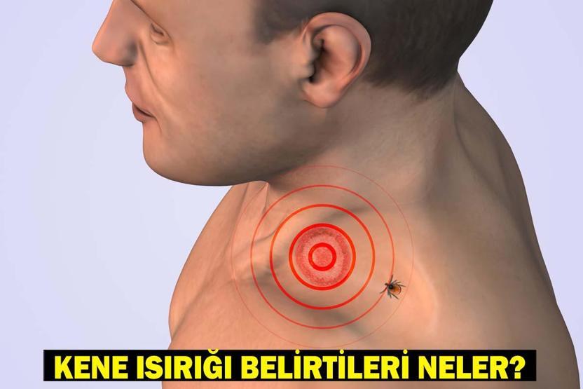 KENE ISIRIĞI BELİRTİLERİ: Kene ısırığı nasıl belli olur Kene ısırığında ilk yapılması gereken nedir Keneden korunmak için ne yapmalıyız