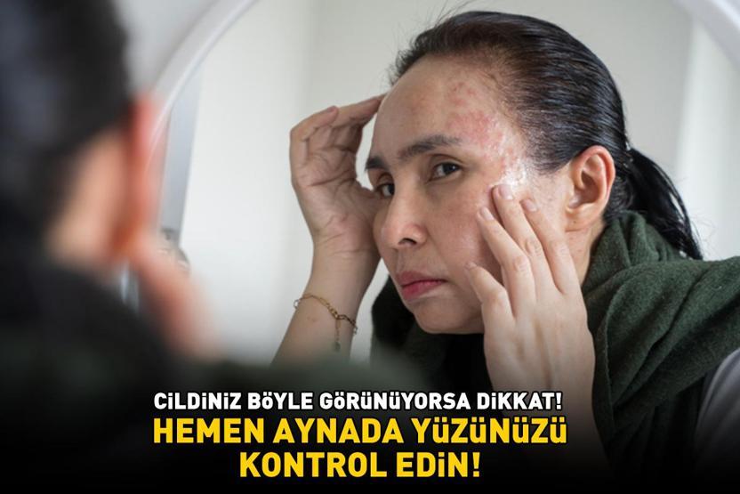 Hemen aynada yüzüne bakın Eğer cildiniz böyle görünüyorsa dikkat Sağlıksız bağırsakların 6 uyarı işareti