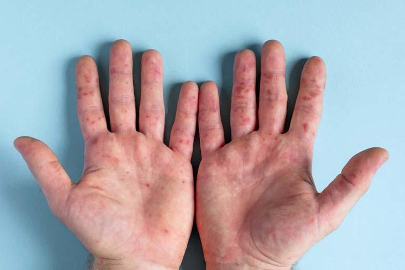 5 Yaş Altı Çocuklarda Daha Sık Görülüyor Belirtileri Arasında Ateş, Vücut Döküntüleri, Boğaz Ağrısı Var... Bu Hastalığa Dikkat