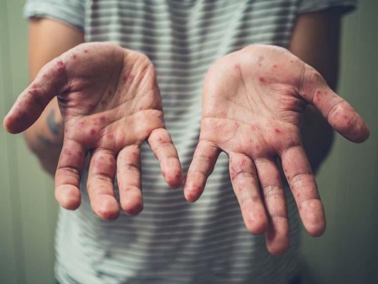 5 Yaş Altı Çocuklarda Daha Sık Görülüyor Belirtileri Arasında Ateş, Vücut Döküntüleri, Boğaz Ağrısı Var... Bu Hastalığa Dikkat